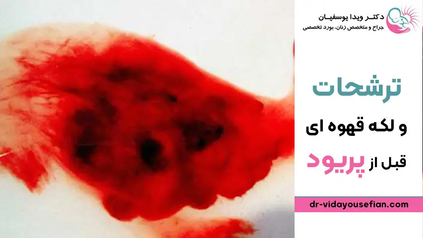 لکه بینی