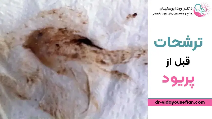 عکس ترشح قهوه ای در بارداری