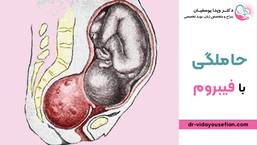 حاملگی با فیبروم اینترامورال