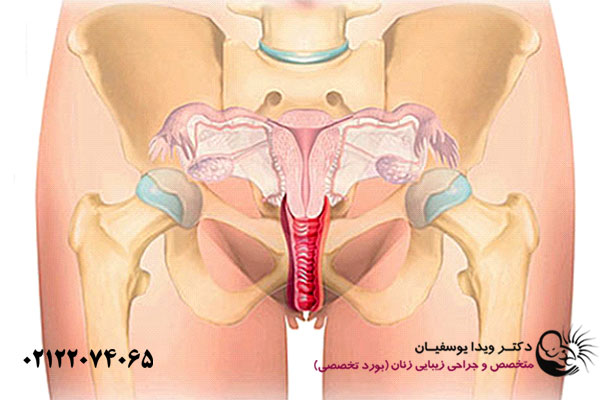 مراقبت های جراحی ترمیمی واژن
