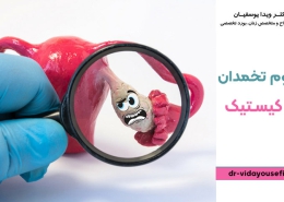سندروم تخمدان پلی کیستیک