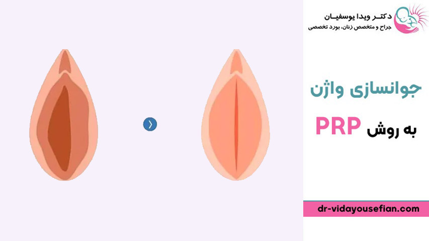 بیماری های قابل درمان با PRP واژن