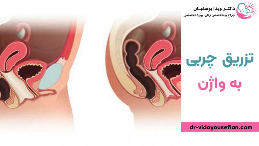ماندگاری تزریق چربی به واژن
