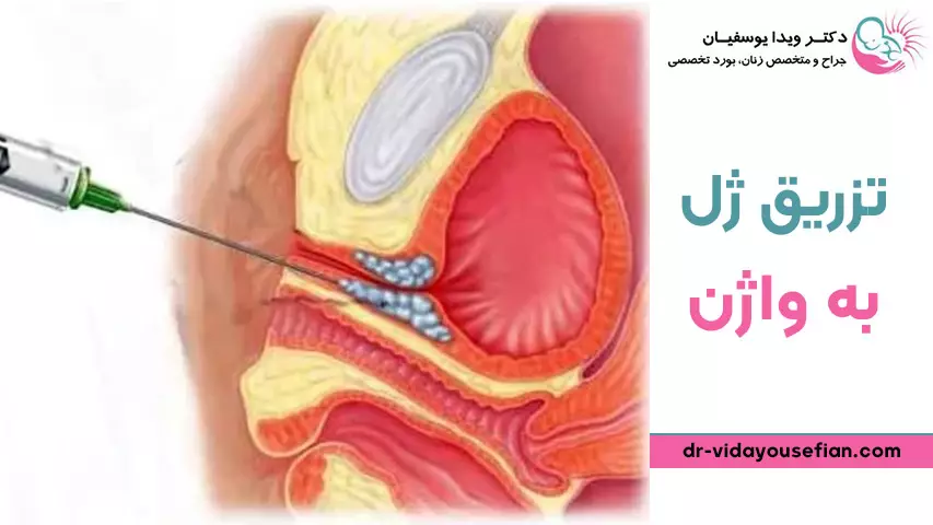 آیا تزریق ژل به واژن ضرر دارد؟
