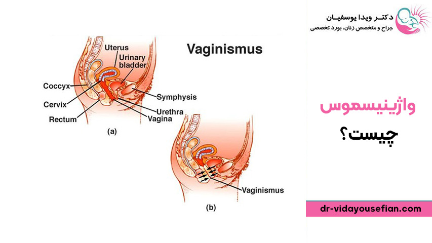 واژینیسموس چیست