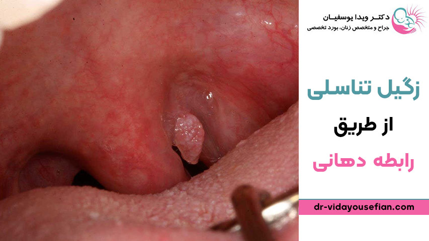 عوارض انتقال زگیل تناسلی از طریق رابطه دهانی