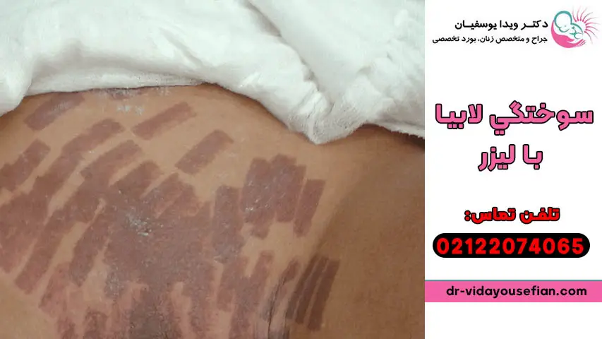 سوختگي لابيا با ليزر