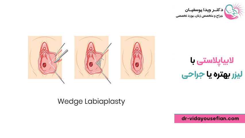 لابیاپلاستی با لیزر بهتره یا جراحی ؟