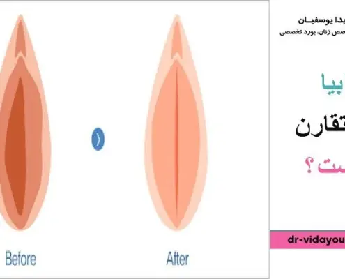 لابیا نامتقارن