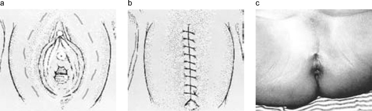 مرحل کلیتوریداکشن